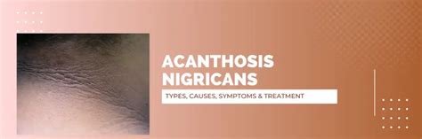 Acanthosis Nigricans Types, Causes, Symptoms & Treatment | USHC