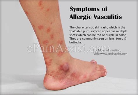 Symptoms of Hypersensitivity Vasculitis or Allergic Vasculitis ...