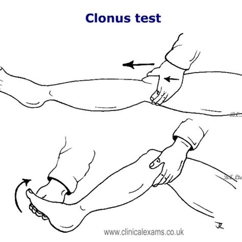 발목 클로누스(Ankle clonus) : 네이버 블로그