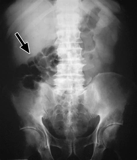 Pneumatosis Intestinalis in the Adult: Benign to Life-Threatening Causes | AJR