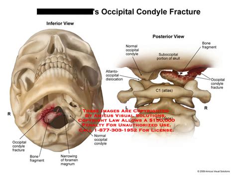 AMICUS Illustration of amicus,injury,fracture,condyle,occipital,bone ...