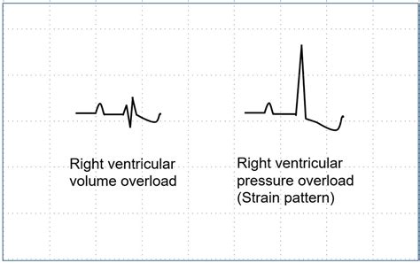 Chamber enlargements on ECG – All About Cardiovascular System and Disorders