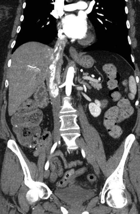 Radiological Case: Intravenous leiomyomatosis • APPLIED RADIOLOGY