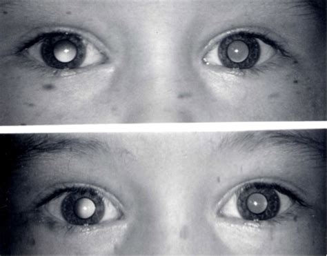 Anisometropic Amblyopia: 5 year-old male with unequal vision.