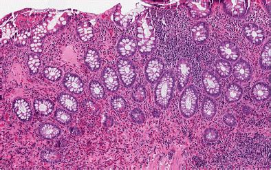 Eosinophilic colitis pattern of injury. This sigmoid colon biopsy shows... | Download Scientific ...