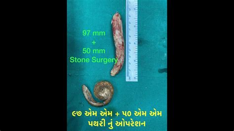 Open Ureterolithotomy + Cystolithotomy for Forgotten Stentoliths - YouTube