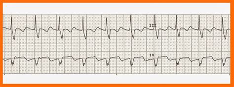 Float Nurse: Practice EKG Rhythm Strips 211