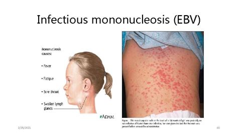 Mononucleosis Rash : Common viral rashes include mononucleosis, chickenpox, and shingles.