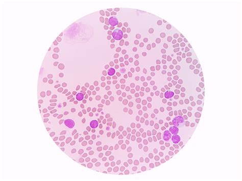 Low Lymphocytes And Eosinophils