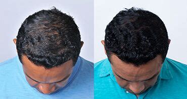 Theradome Laser Hair Growth Reviews | Laser Helmet Results