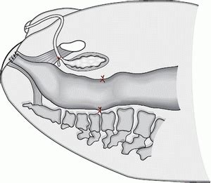 Laparoscopic-Assisted Anorectal Pull-Through for Anorectal Malformations | Obgyn Key