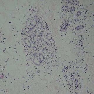 Typical cryopyrin-associated periodic syndrome rash showing figurate... | Download Scientific ...