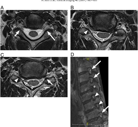 Comparison of MRI grading for cervical neural foraminal stenosis based ...