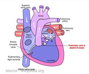 Pulmonary Atresia - Types, Symptoms, Diagnosis and Management