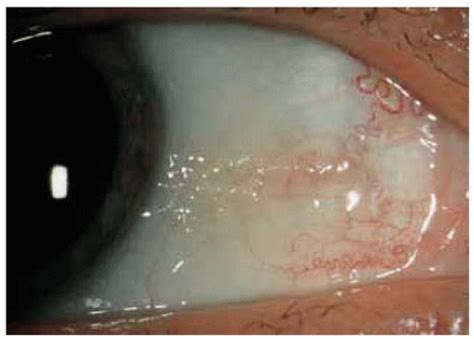 Premalignant and Malignant Lesions of the Conjunctival Epithelium | Ento Key