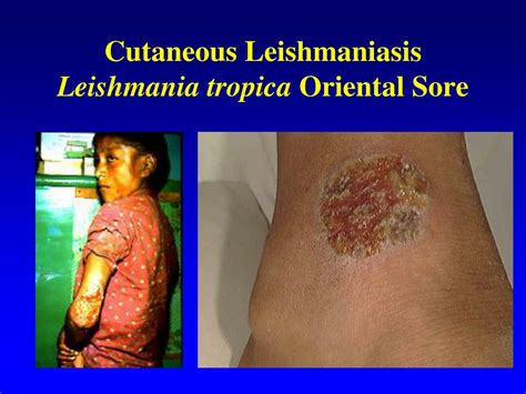 PPT - Cutaneous Leishmaniasis Leishmania tropica Oriental Sore PowerPoint Presentation - ID:206675