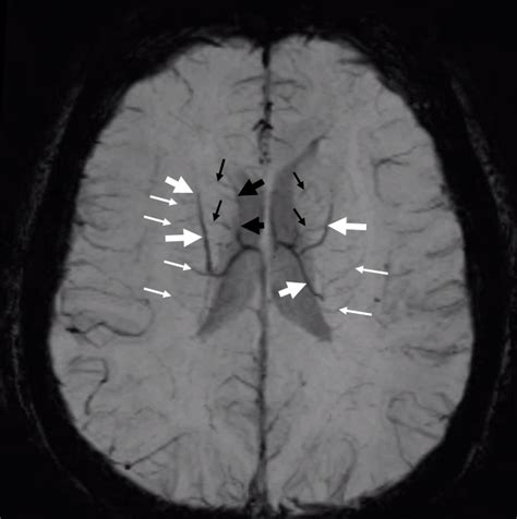 Internal Cerebral Vein | neuroangio.org