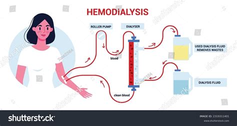 Hemodialysis Dialysis Procedure Method of - Royalty Free Stock Vector ...