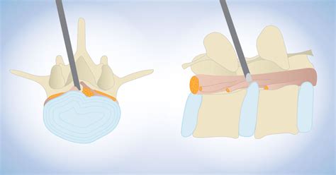 Intralaminar Lumbar Micro-Endoscopic Discectomy | Scottsdale, AZ Orthopedic Spine Surgery