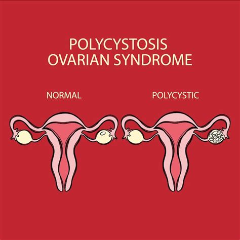 Premium Vector | POLYCYSTIC OVARIAN SYNDROME VS NORMAL Reproductive System