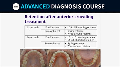 4. Retention after Crowding Treatment