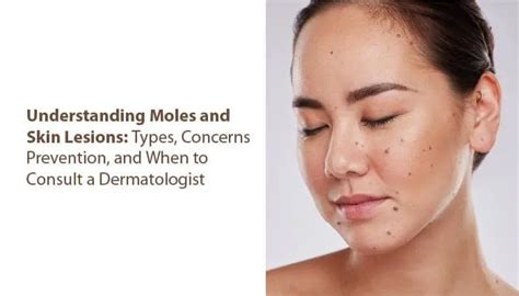 Understanding Moles and Skin Lesions: Types, Concerns, Prevention, and When to Consult a ...