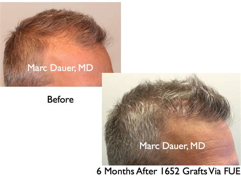 FUE Hair Transplant Results and Donor Zone After 6 Months | Marc Dauer, MD Hair Transplant ...