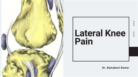 Lateral Knee Pain [Treatment & Exercises] - Dr. Ramakant