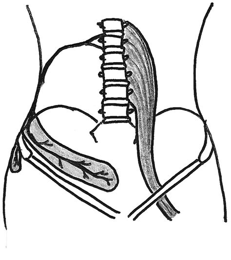 Osteopathic Approach to the Treatment of a Patient With Idiopathic ...