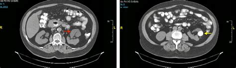 Ultrasound-Guided Access in a Malrotated Kidney: Optimally Safe and ...