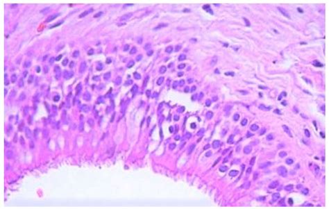 Photomicrograph of the excised maxillary sinus mucocele shows a cystic... | Download Scientific ...