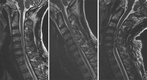 Cervical kinematic MRI of spinal cord injury in a 44‐year‐old male ...