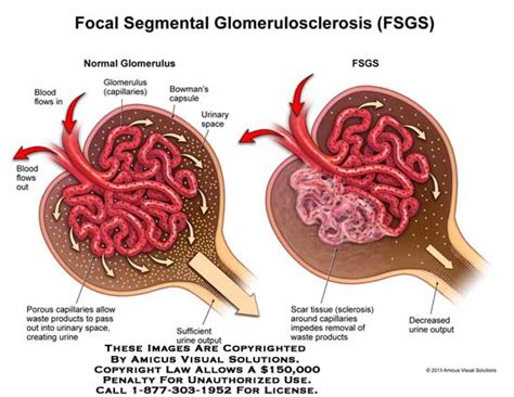 Renal-disease: Hot topic: Focal Segmental Glomerulosclerosis (FSGS) and its treatment