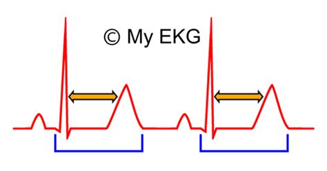 Hipocalcemia en el Electrocardiograma