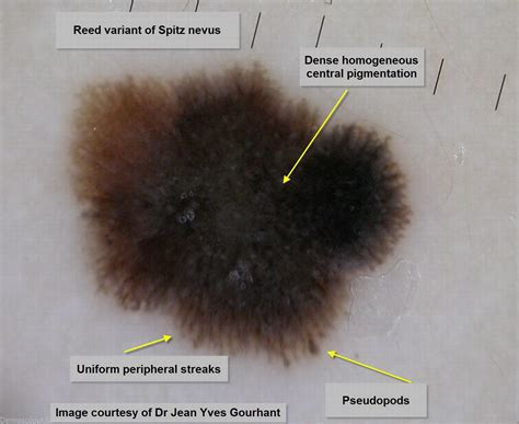 lentiginous compound nevus - pictures, photos