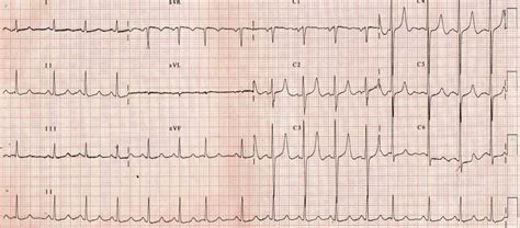 Tall peaked T waves – All About Cardiovascular System and Disorders