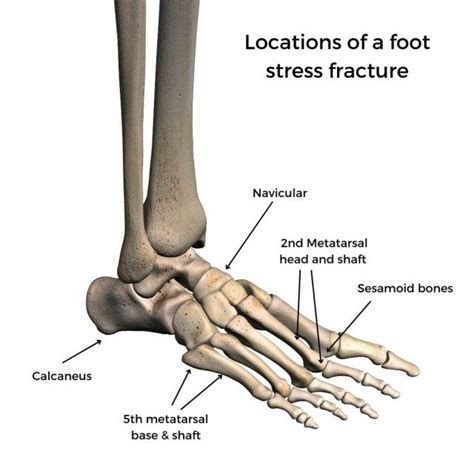 Metatarsal Bone Fracture