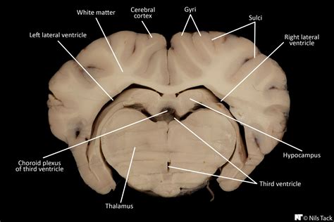 Third Ventricle Sheep Brain