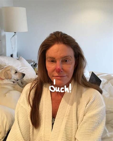 Caitlyn Jenner Shares Painful 'Sun Damage' Pic — OUCH! | Kim kardashian ...