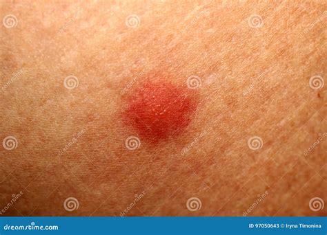 Red Mosquito Bites. Swelling of the Skin. a Bite of a Wasp, a Bee ...