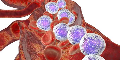 Drug-Resistant Acute Lymphoblastic Leukemia and Relapse May Be Caused by Thiopurines