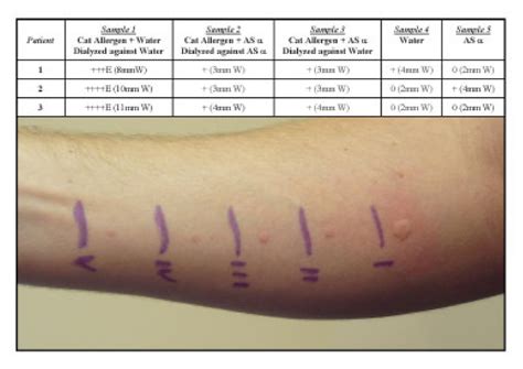 Aluminum sulfate significantly reduces the skin test response to common allergens in sensitized ...