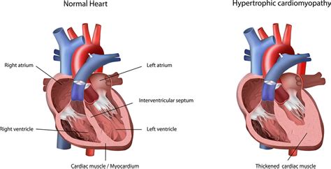 Hypertrophic Cardiomyopathy - Symptoms and Causes | Dr Raghu