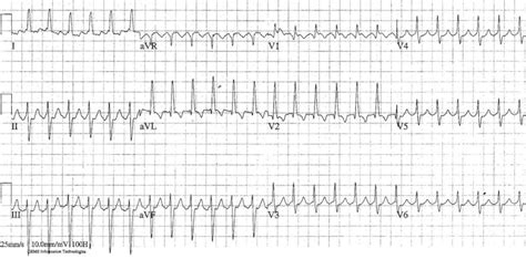 Atrial Flutter • LITFL • ECG Library Diagnosis