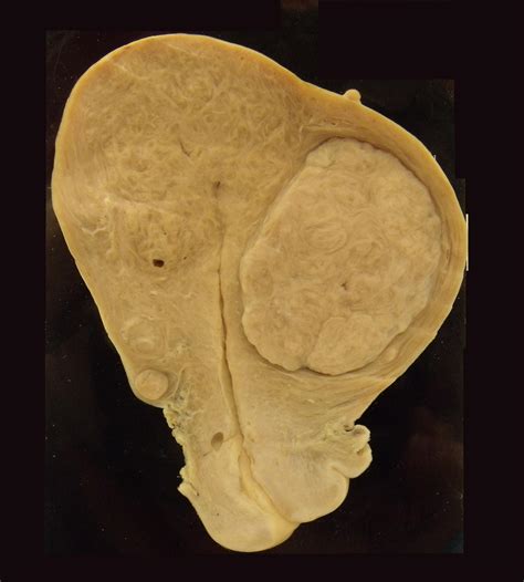 Adenomyosis