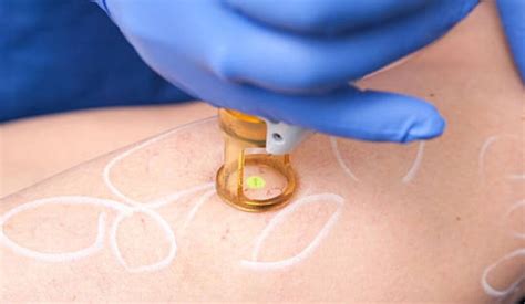 Uncovering the Benefits of Laser Treatment for Spider Veins