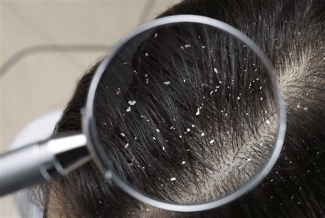 Causes of an Itchy Scalp - Is It Head Lice? - Lice Clinics USA Is It ...