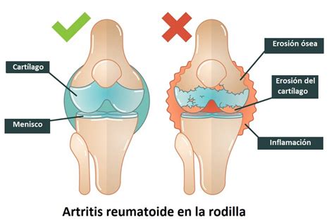 Síntomas, causas y prevención de la artritis reumatoide | Tu canal de salud