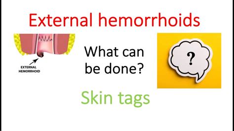 External Hemorrhoids Photos