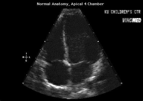 This is how a normal Echocardiogram looks ! Images - Frompo